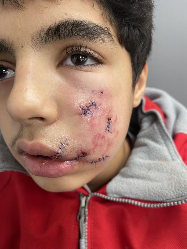 Muhammad Almutaz Alzghool, 13, was allegedly bitten in the face by a dog previously confiscated on suspicion of being a pit bull.
