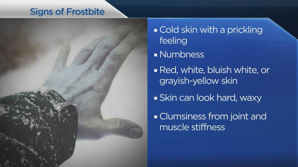 Click to play video: 'Recognition of signs of freezing and hypothermia'
