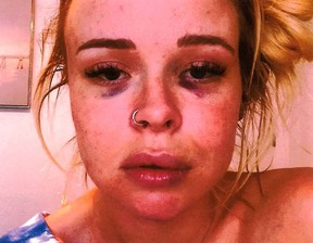This unidentified woman's two black eyes allegedly came from Dodgers hurler Trevor Bauer.  He has denied any wrongdoing.  The photo was released to the media by the woman's lawyer.