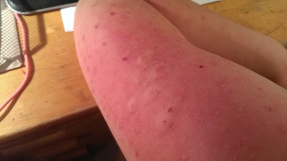 Bedbug bites on arms. 