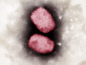 The first case of monkeypox in BC was detected in a Vancouver Coastal Health resident and had been confirmed via lab testing in the province.  The case has now been forwarded to the National Microbiology Laboratory for further confirmation.